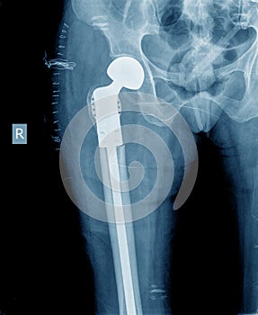 X-ray of hip prosthesis