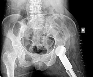 X-ray of hip prosthesis