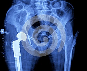 X-ray of hip prosthesis