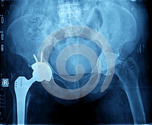 X-ray of hip prosthesis