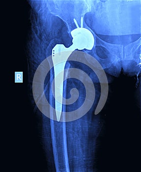 X-ray of hip prosthesis