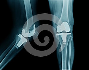 Knee joint replacement or TKA photo