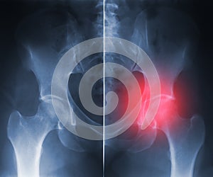 X-ray hip trauma