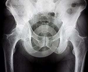 X-ray of the hips