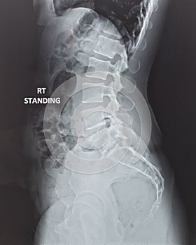 X-ray of human back spine cord radiography with digital imaging film display internal organ of woman patient`s health ribs, pelv