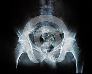 X-ray of a human break hip coxal joint