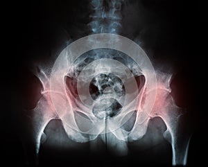 X-ray of a human break hip coxal joint