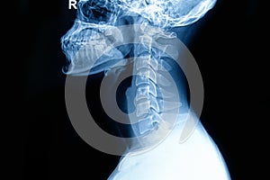X-ray of human cervical spine