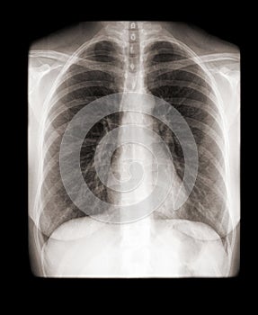 X-ray of a human chest front view