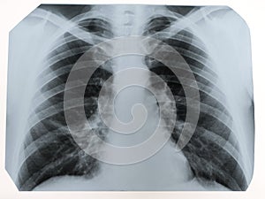 X-ray of a human chest or lungs radiography shot, medical techno