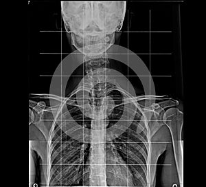 X-ray of human chest and spinal column, front view