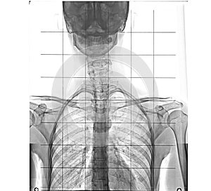 X-ray of human chest and spinal column, front view