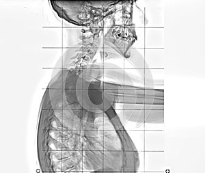 X-ray of human chest and spinal column, side view