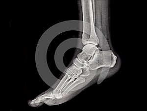 An x-ray of the human foot and ankle