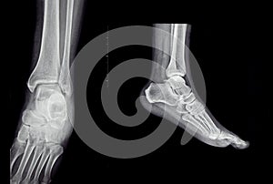 An x-ray of the human foot and ankle