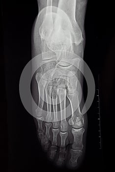 An x-ray of the human foot and ankle