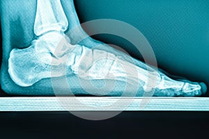 X-ray human foot with flatfoot