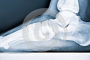 X-ray human foot with flatfoot, close-up