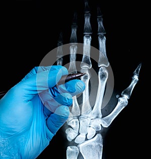 X-ray of human hand with doctor`s hand in glove