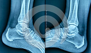 X-ray of human heel spur