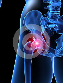 X-ray human hip