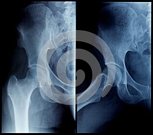X-Ray human hip