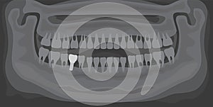 X-ray of human jaw with normal teeth and dental implant. Radiograph with prosthesis in gum