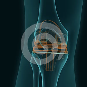 X-ray of a human knee in the frontal projection with knee replacement