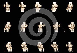 X-ray human knee joints finding fracture proximal metaphysis of tibia.Healthcare and insurance concept