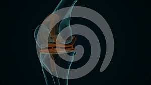 X-ray of a human knee with knee replacement