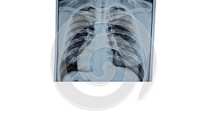 X-ray of human lungs on isolated white background