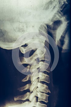 X-ray of human neck, vertebra or spine