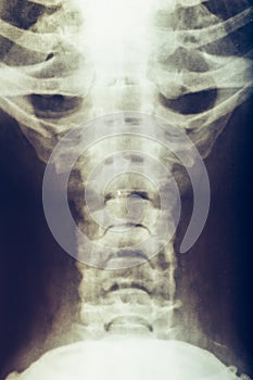 X-ray of human neck, vertebra or spine