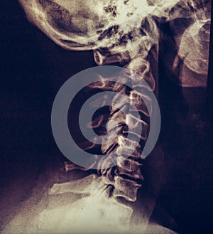 X-ray of human neck, vertebra or spine