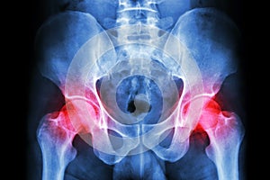 X-ray human's pelvis and arthritis at both hip joint (Gout , Rheumatoid) photo
