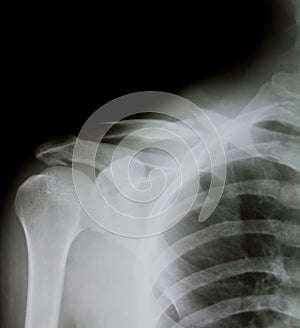 X-ray of human shoulder (broken shoulder)