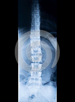 X-ray of human spinal column