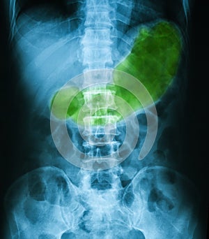 X-ray image of Abdomen, supine position.
