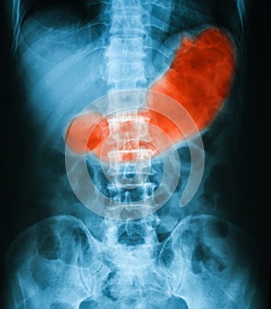 X-ray image of abdomen, supine position,