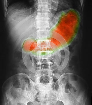 X-ray image of abdomen supine position, show gastric juice photo
