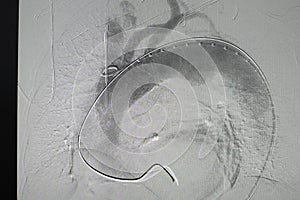 X-ray image. Angiogram of right common iliac artery after aortic stent graft