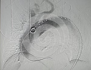 X-ray image. Angiogram of right common iliac artery after aortic stent graft