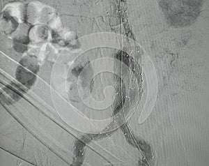 X-ray image. Angiogram of right common iliac artery after aortic stent graft