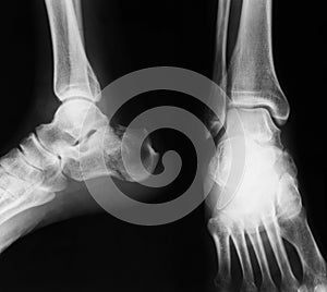 X-ray image of ankle, AP and Lateral view.
