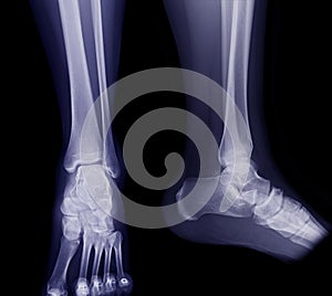 X-ray image of ankle joint .