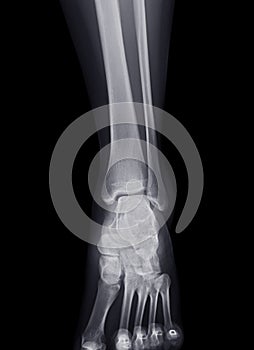 X-ray image of ankle joint.