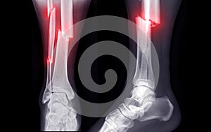 X-ray image of ankle joint showing fracture tibia and fibula bone