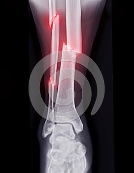 X-ray image of ankle joint showing fracture tibia and fibula bone