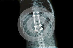 X-ray image of back pain with implant