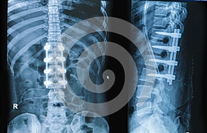 X-ray image of back pain show spinal column with implant fusion